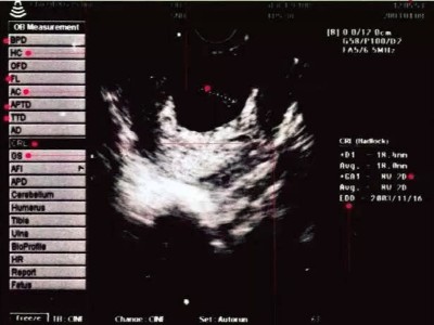 当妈妈们拿到B超纸，B超纸该如何看呢-苏州hjc888黄金城